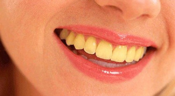 Causes Teeth to Look Yellow