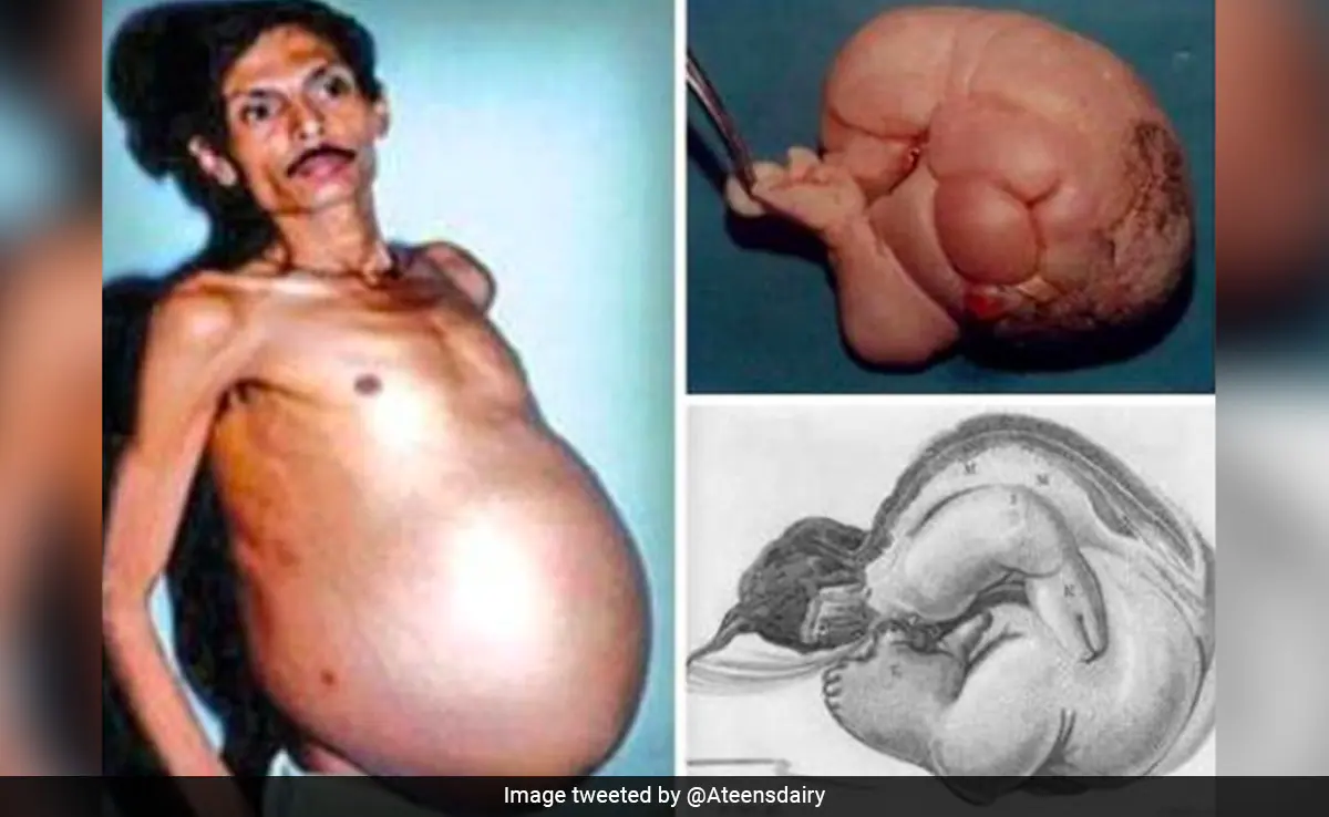 fetus in fetu"
