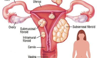 Fibroids