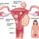 Fibroids