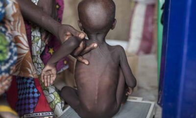 Malnourished in Northeast and Northwest