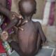 Malnourished in Northeast and Northwest