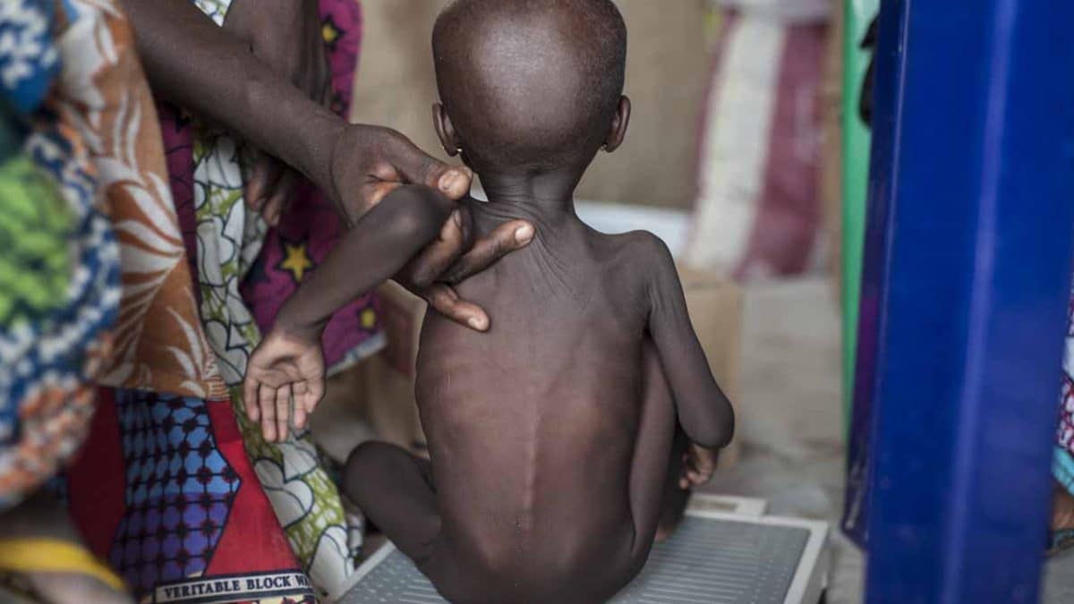 Malnourished in Northeast and Northwest