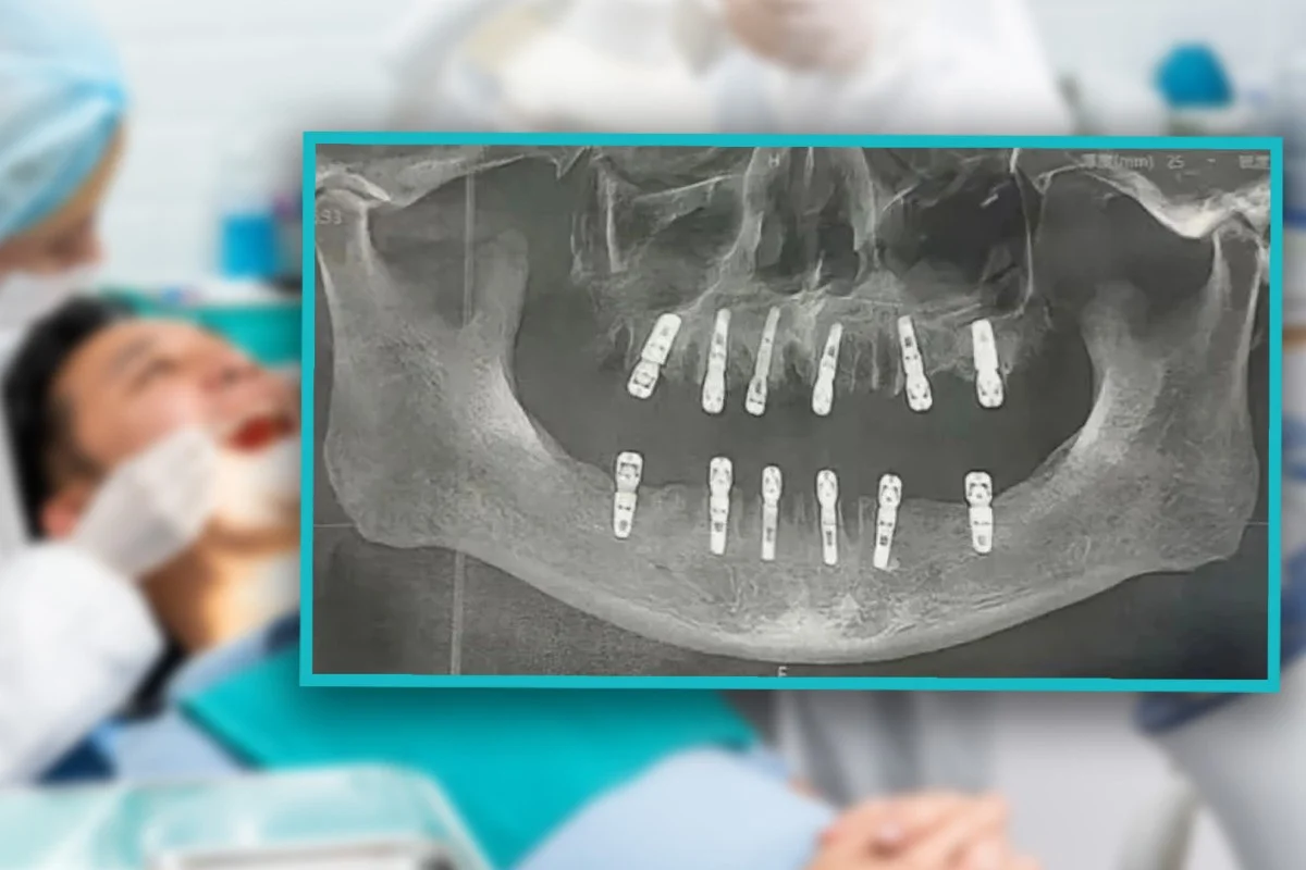 Teeth Extracted