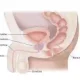 Expert: No diet or sexual activity can prevent prostate cancer, warns urologist